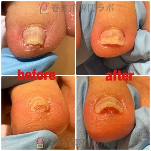 【50代女性・巻き爪症例】3趾（足の中指）の爪が厚く高くなり靴下に引っかかる…1回のケアで引っかかりを解消｜巻き爪専門ラボ