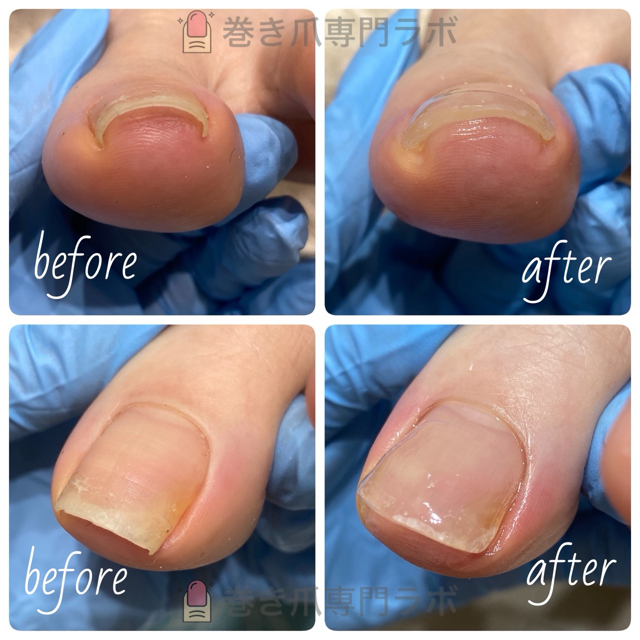 旅行中の歩行で痛む巻き爪を1回で緩和した症例のBefore/After｜巻き爪専門ラボ