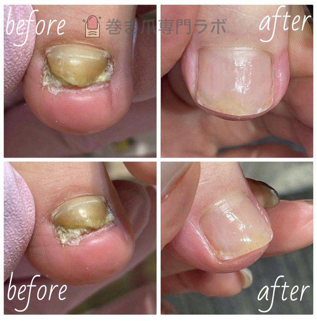肥厚爪の劇的ビフォーアフター