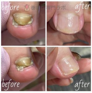 肥厚爪の劇的ビフォーアフター