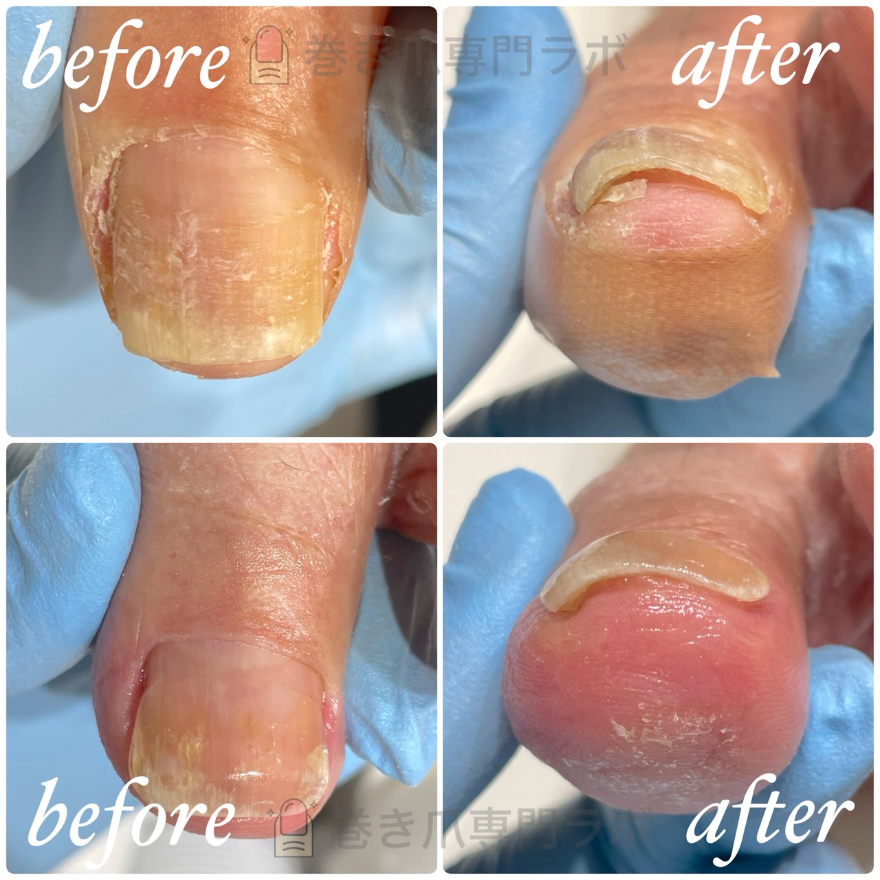 厚みが出て痛みが強くなった50代男性の巻き爪を1回で広げた症例のBefore/After｜巻き爪専門ラボ