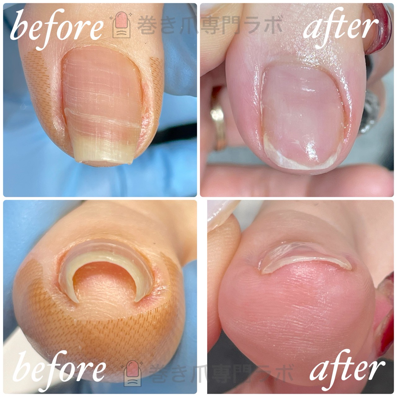 巻き爪の初回施術ビフォーアフター（爪の食い込みが上がり平らに広がる様子）