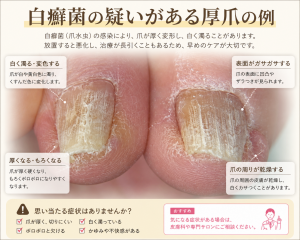 【巻き爪と糖尿病の関係性】小さな傷が重症化リスクに？放置厳禁な理由と安全な足元ケア｜巻き爪専門ラボ