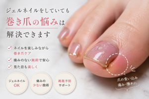 ジェルネイルが巻き爪を引き起こす？5つの影響と後悔しない簡単予防策｜巻き爪専門ラボ