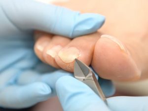 【巻き爪の正しい切り方】深爪は絶対NG！予防と再発を防ぐ「スクエアオフ」の作り方｜巻き爪専門ラボ