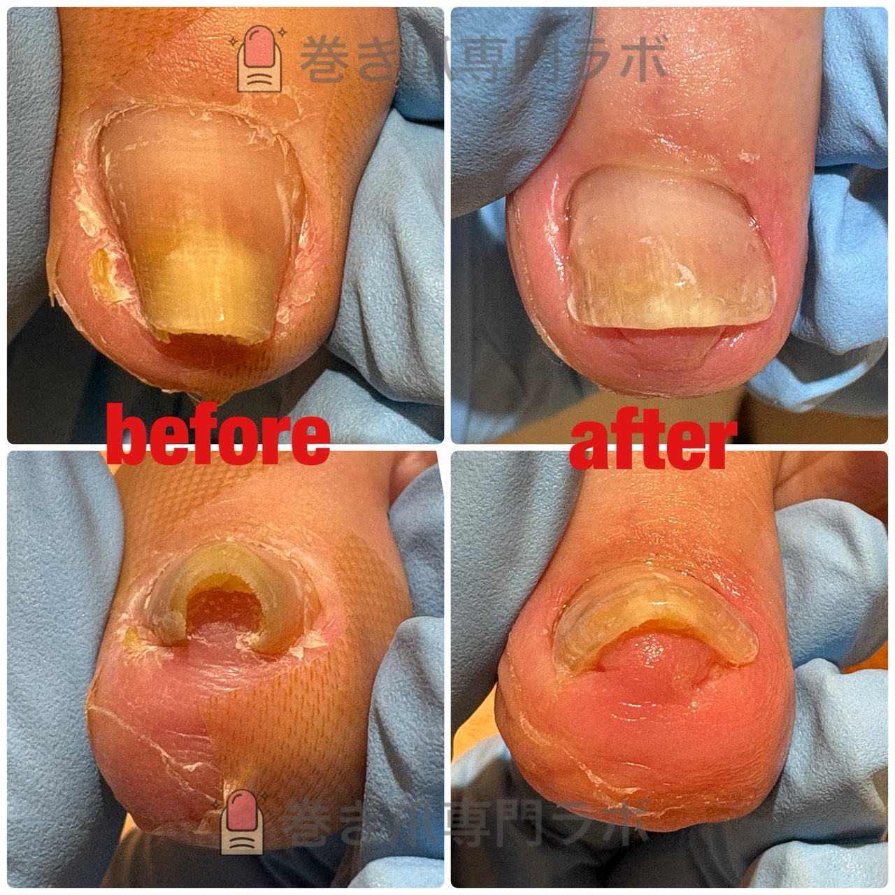 50代女性の痛くて歩けない巻き爪を1回で平らに広げた症例のBefore/After｜巻き爪専門ラボ