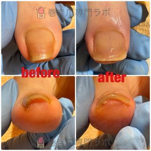 【巻爪症例】靴が当たると痛い巻き爪が改善！50代女性の事例｜巻き爪専門ラボ