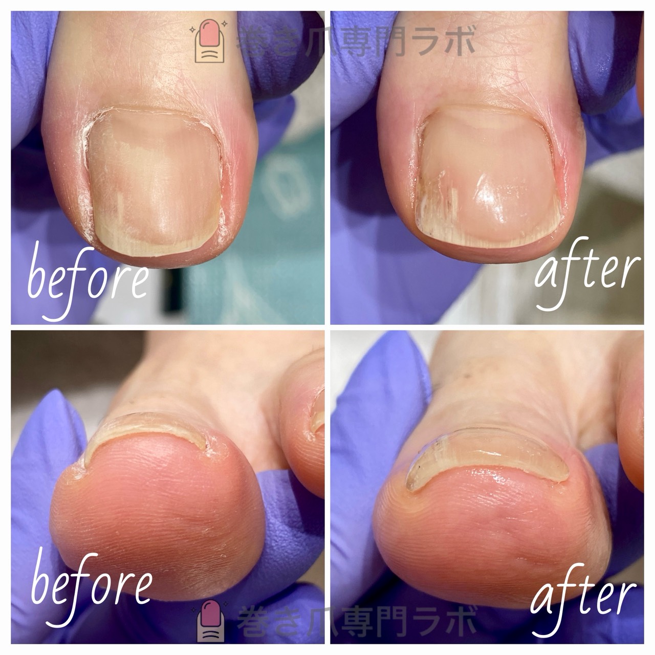 30代女性 巻き爪矯正 Before After