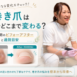 【巻き爪は一回でどこまで変わる？】初回施術のビフォーアフターと通院目安｜巻き爪専門ラボ