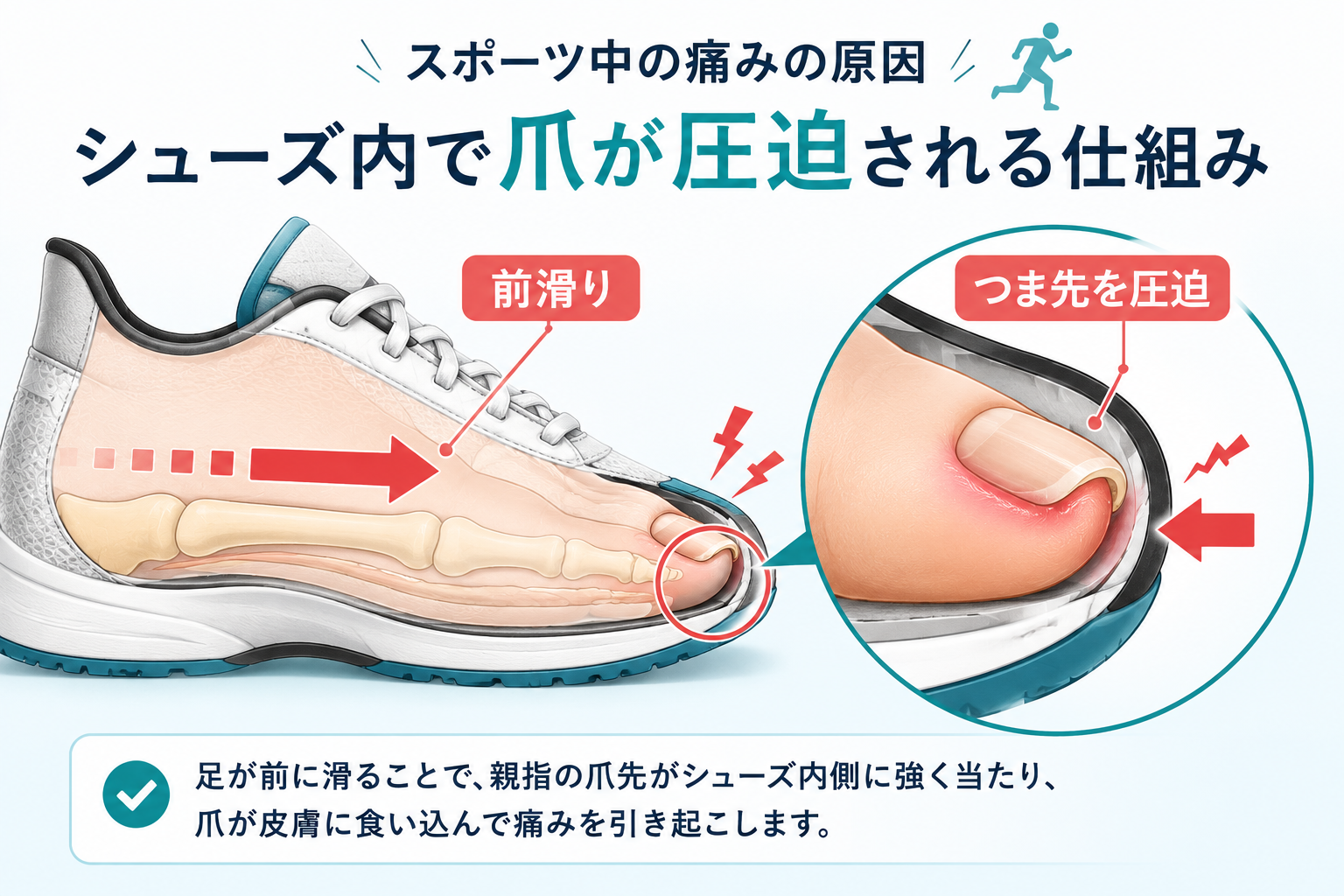 スポーツシューズ内で足の親指と巻き爪が圧迫されるメカニズム