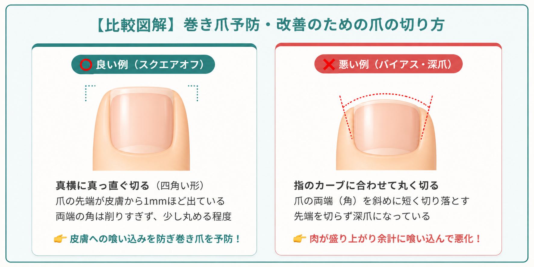 【比較図解】巻き爪予防・改善のための爪の切り方 良い例（スクエアオフ）と悪い例（バイアス・深爪）