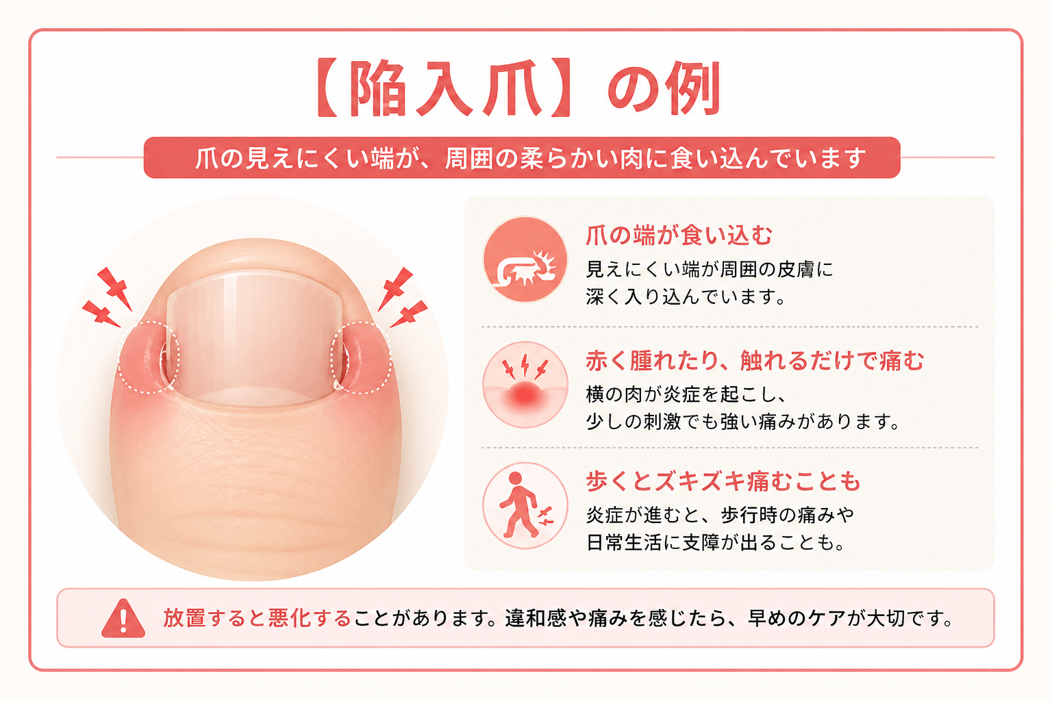 【陥入爪】の例：爪の見えにくい端が周囲の柔らかい肉に食い込み赤く腫れている状態