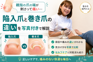 【親指の爪の端が刺さって痛い】陥入爪と巻き爪の違いを写真付きで解説｜巻き爪専門ラボ