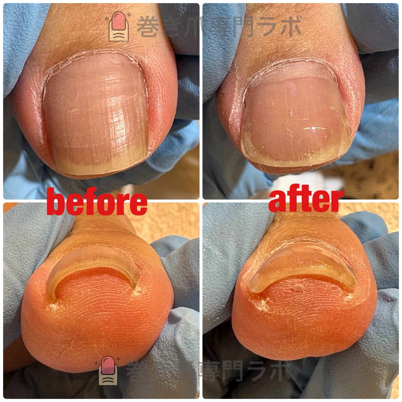 50代女性の巻き爪施術ビフォーアフター（Before: 爪の端が皮膚に巻き込んでいる状態 / After: 補正により爪の端がしっかりと広がり自然なアーチになった状態）